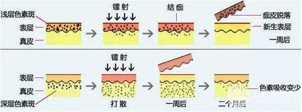 华西医院激光祛斑价格多少？术前术后注意事项汇总~