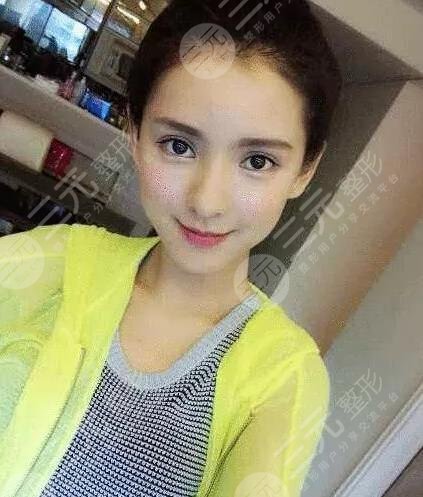 张予曦是不是整容