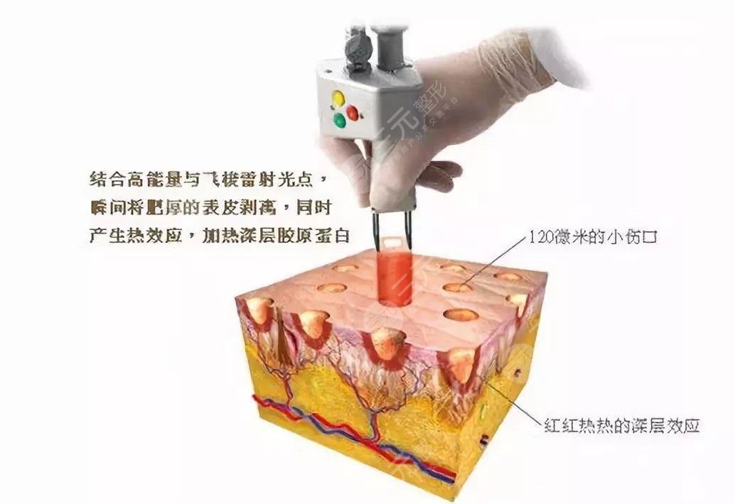飞梭镭射和点阵激光的区别汇总,哪个好一点?-城市惠