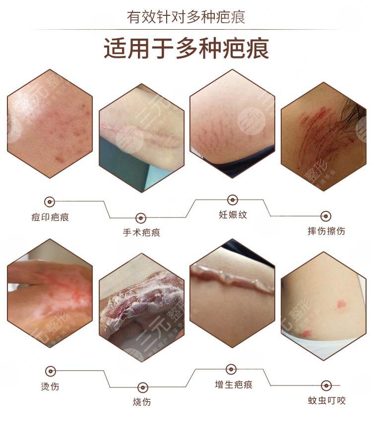 管城区除疤新趋势:追求美丽不留疤痕