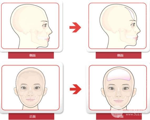 额头窄丰额头多少钱？这3种方法可以选择~-城市惠