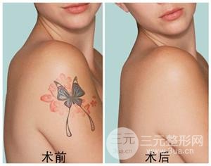 洗纹身要多少钱一次？受3点因素影响~