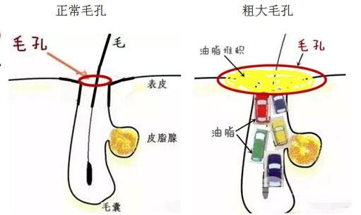 激光治疗毛孔粗大价格 “反孔精英”就是它~