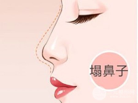 [科普]假体隆鼻手术的果，一抬头2D脸变成3D立体脸型~
