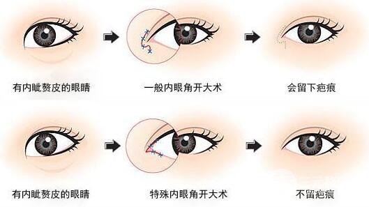 开眼角z容易忽视的潜在危险!