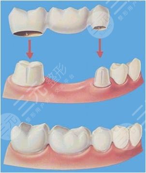 烤瓷牙套掉了怎么?办?多久之内必须粘回去?