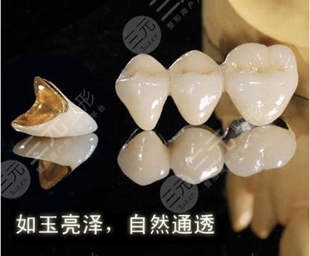 烤瓷牙套掉了怎么?办?多久之内必须粘回去?