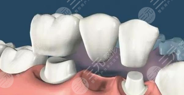 烤瓷牙套掉了怎么?办?多久之内必须粘回去?