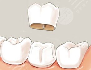 烤瓷牙套掉了怎么?办?多久之内必须粘回去?