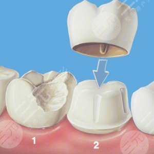 烤瓷牙套掉了怎么?办?多久之内必须粘回去?