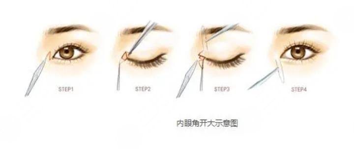 开眼角会使眼睛大吗?女生必看!眼睛变漂亮的小秘诀