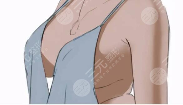 娜绮丽隆胸多少钱更合理？为什么有的姐妹花费11万巨款？是物超所值吗？