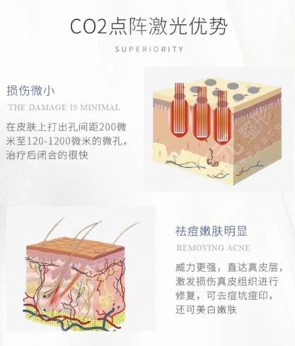 温州医科大学附属第一医院点阵激光案例