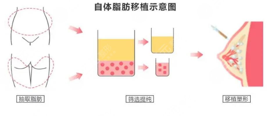 自体脂肪丰胸手术