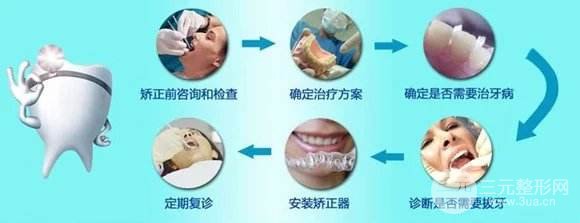 牙齿矫正过程