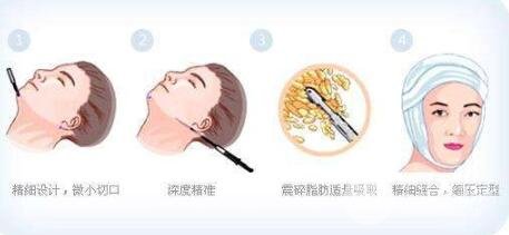 上海九院面部吸脂多少钱?