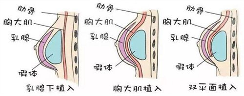 上海美姿医疗美容医院隆胸案例