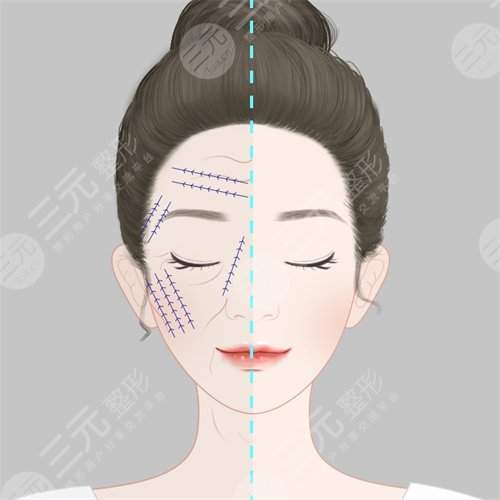深圳江南春天医院祛皱案例案例：