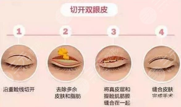 全切双眼皮