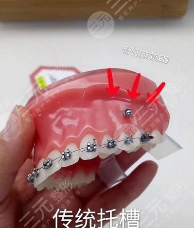 金属矫正牙齿