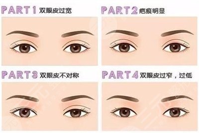 九院整形双眼皮果