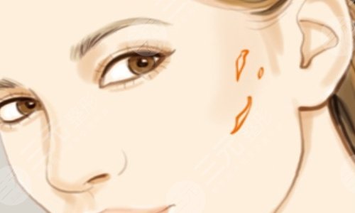 上海九院激光美容科激光祛疤案例