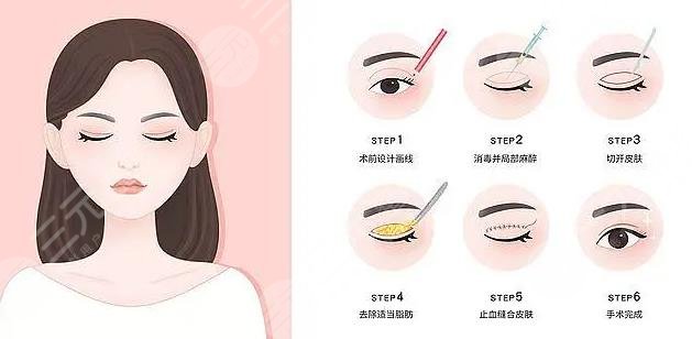 三点和欧式双眼皮哪个好?看?