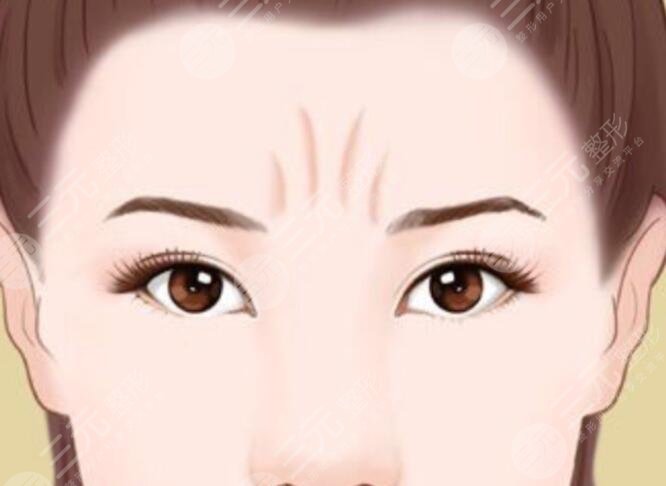 　　怎样去掉两眉间的竖纹?也许是因为年龄的增长，皮肤的状态会变得越来越差，面部的皱纹也就会逐渐的加深，或者是有许多爱皱眉的小伙伴，在经常皱眉过后，双眉之间就形成了比较的皱纹，因为这类皱纹长得像一个川字，也被大家称之为川字纹，两眉间的竖纹，不仅影响了面部的美观程度，也会让人觉得你有一些愁眉苦脸感觉，那么我们应该怎么去掉两眉间的竖纹?  　　一、两眉间长竖纹的原因  　　两眉间长竖纹有许多原因，小编整理了几个生活中常见的，导致两眉间生出皱纹的原因。首先是，随着年龄的增长，皮肤它会自然的老化，所以，面部皱纹就会形成比较的沟壑，你就会出现咱们所说的双眉竖纹。第二点，是咱们年轻的小伙伴喜欢做皱眉的动作，或者经常使用电脑手机等电子产品，也会加速皮肤的老化速度，从而形成两眉间的竖纹。  　　第三，就是咱们不注重防晒，其实大家都知道紫外线对皮肤的伤害是很大的，不注重防晒不仅会产生的色斑，还能加速皮肤老化，如果不注重防晒也就比较容易形成双眉间的竖纹。后，是咱们身体缺乏了营养，有的小伙伴她不喜欢吃富含维生素的蔬菜和水果，也不喜欢吃富含胶原蛋白的食物，也就导致皮肤缺乏了营养物质，从而也就形成了双眉间的皱纹。  　　二、日常生活中的去皱小妙招  　　那么，日常生活中有哪些方法可以改善眉间的竖纹?小编为大家分享几个方法来改善两眉间的竖纹。首先是按摩法，咱们的拇指从眉心开始往上走，食指，就沿着眼睛的周围做按摩，每天重复二十次，能够有的改善两眉间的竖纹，但是需要注意的是，咱们在按摩之前，需要现在面部涂抹面霜，不然的话，摩擦力过大也会导致皮肤的损伤。  　　其次，是做好面部的护理，我们每天在清洁脸部过后就必须做好补水保湿的工作，在使用水乳的时候可以轻轻怕打额头的肌肤，让水乳等护肤品能够渗透到肌肤里面，然后，用手掌把眉间的皮肤慢慢轻轻的推到发际线处，推五次即可，这样也能很好的改善咱们双眉间的竖纹。后，咱们应该改变一下自己的生活作息，我们应该避免熬夜，避免抽烟喝酒，在日常生活当中，多吃一些豆制品，蔬菜和瓜果，以及多吃富含胶原蛋白的食物，这样也能够有的去眉间竖纹。  　　三、医疗美容手段除皱  　　日常的按摩手法以及食疗的方法，只能够改善眉间纹的一个状态，如果我们想要去除眉间纹的话，我们应该选择使用医疗美容的方式。常见的方式有两种，首先一种是局部注射的方法，这种方法的果比较，因为注射的药剂，它可以起到一个麻痹神经，降低注射部位的肌肉运动状态的一个作用，通俗来讲，就是能够减少咱们皱纹的一个动作，但是这种药剂的注射一般只能维持半年左右，所以我们需要重复注射。  　　但是一年建议不要超过两次注射，一年内注射次数过多的话，可能会对身体产生一些副作用。。第二，就是填充法当眉间的皱纹比较深的时候，我们就需要注填充物，来填充咱们眉间的沟壑，一般填充的填充物会选择自己身上的脂肪细胞，不会出现排异现象，这种方式，比较适合两眉间的竖纹很深的小伙伴，而且手术费用相对来说也会比较高，小伙伴们可以多多了解过后再进行选择。