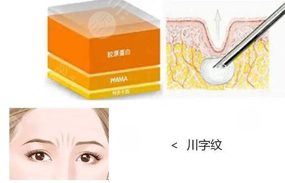 两眉间长竖纹的原因