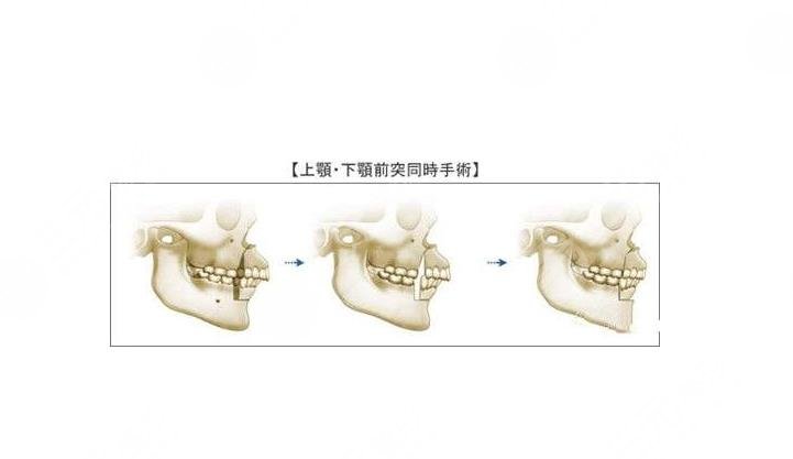 北京大学口腔医院口腔颌面外科正颌科普信息