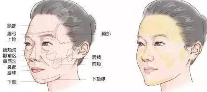 除皱