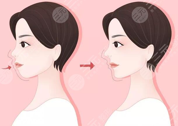 凸嘴问题需要矫正才能改善，如何改善?