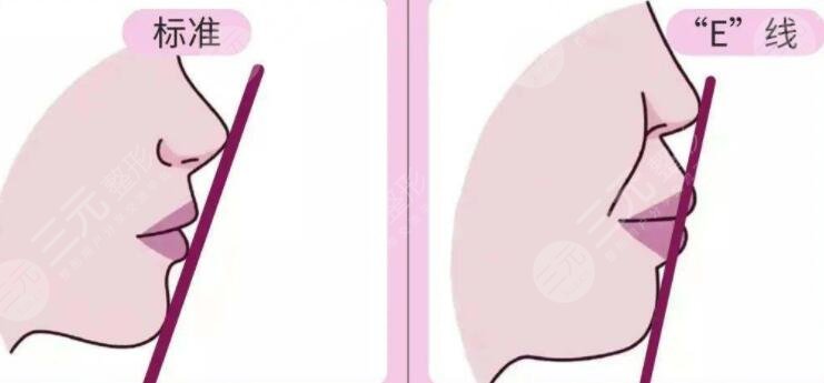 凸嘴问题需要矫正才能改善，如何改善?