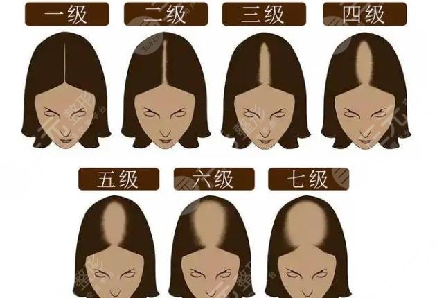 脱发等级