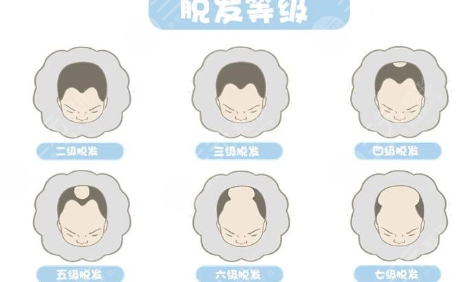脱发等级