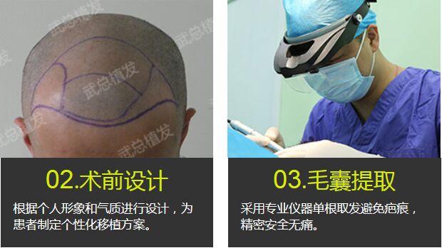武汉,武总植发,专科,门诊,特惠,价格表,来啦