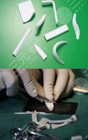 自体脂肪隆鼻是什么呢