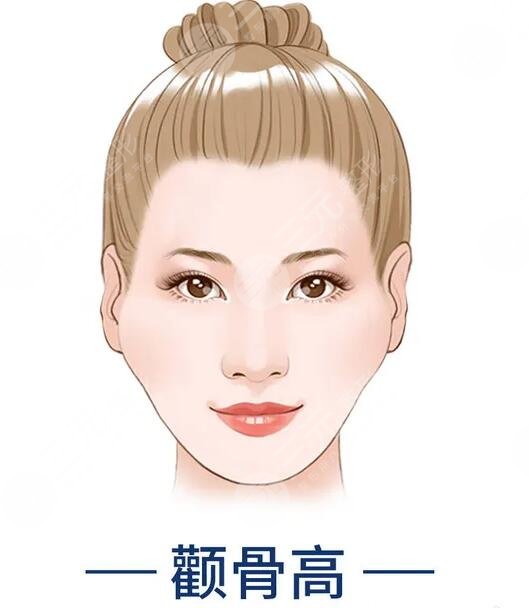 颧骨高适合什么整形项目？
