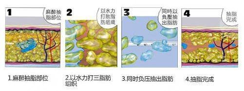 吸脂