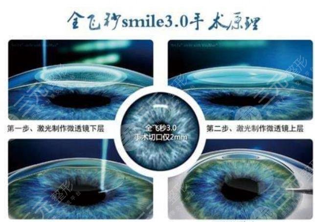 全飞秒近视矫正有没有危险?