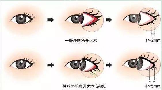 开外眼角恢复时间