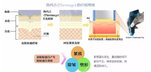 热玛吉多少钱一次?2025价格收费参考
