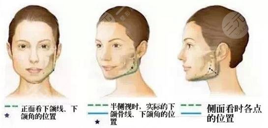 深圳地区下颌角整形案例果展示