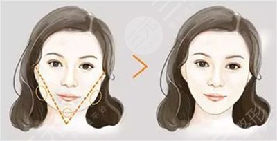 什么是磨骨手术?