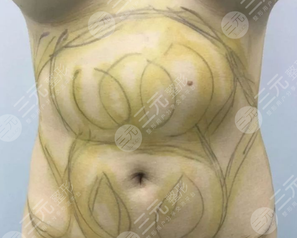 太原宏远爱谛腹部吸脂案例