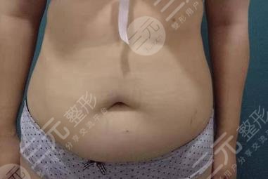 上海佳富美整容医院腹部吸脂案例