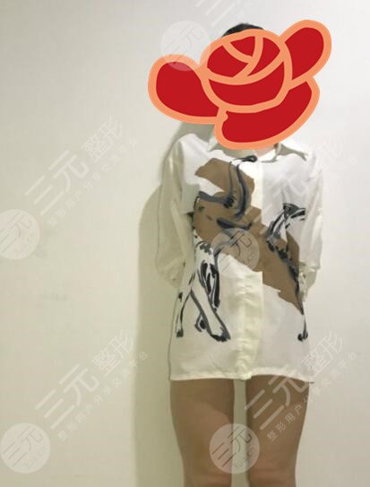 北京京美会医疗医院大腿吸脂案例