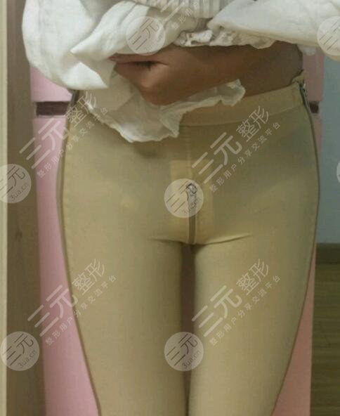 北京京美会医疗医院大腿吸脂案例