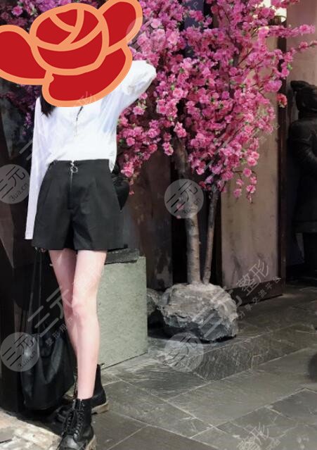 北京京美会医疗医院大腿吸脂案例