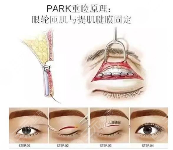 双眼皮原理